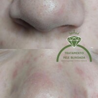 Terapia pele acneica