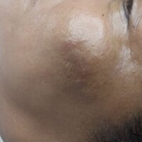 Clareamento de melasma 